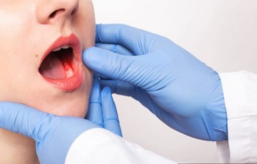 5 Cara Mencegah Kanker Mulut yang Bisa Kamu Lakukan